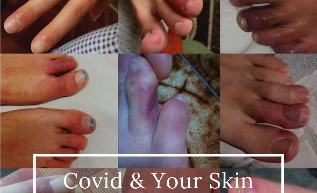 The Skin Signs of Covid-19