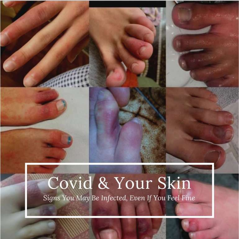 The Skin Signs of Covid-19
