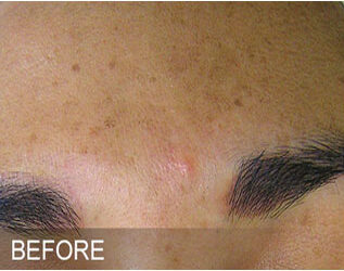 Hydrafacial11
