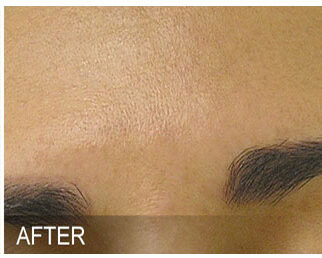 Hydrafacial11