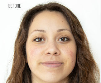 Hydrafacial22