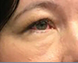 accutite-before-after-1