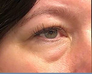 accutite-before-after-1