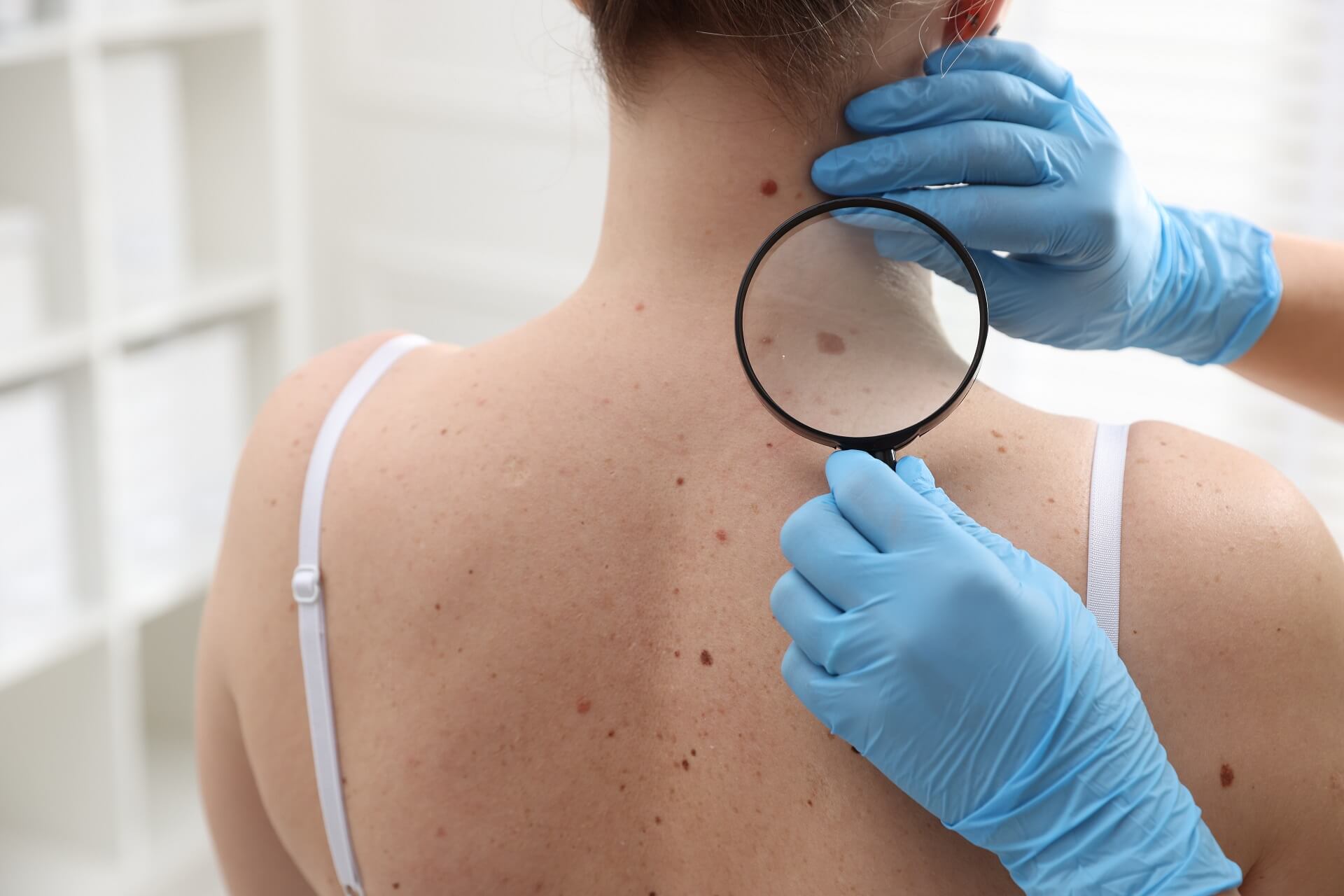 A clinician checking skin with a dermatoscope