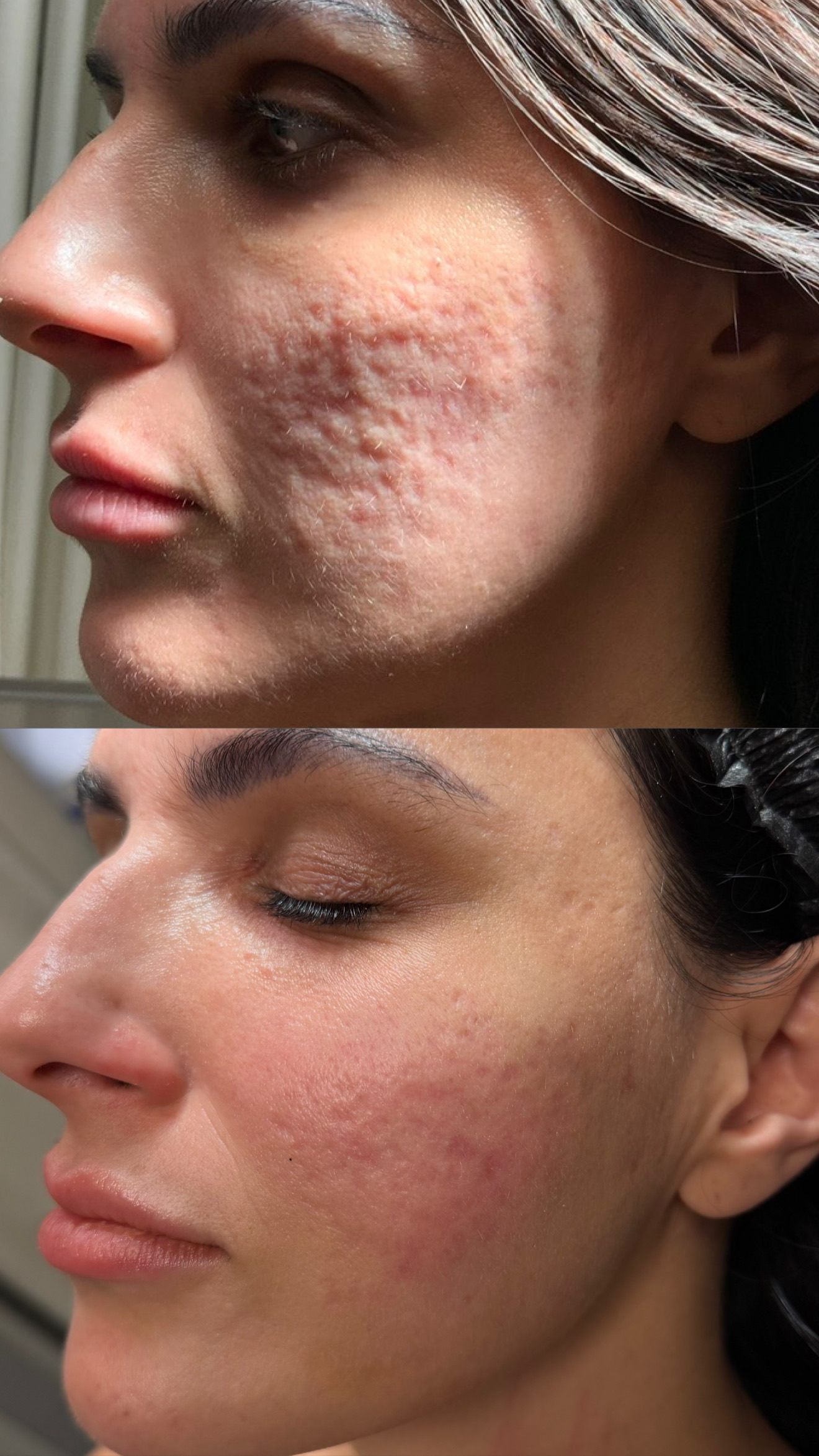 Subscision before-and-after photographs from the Aesthetix Results gallery