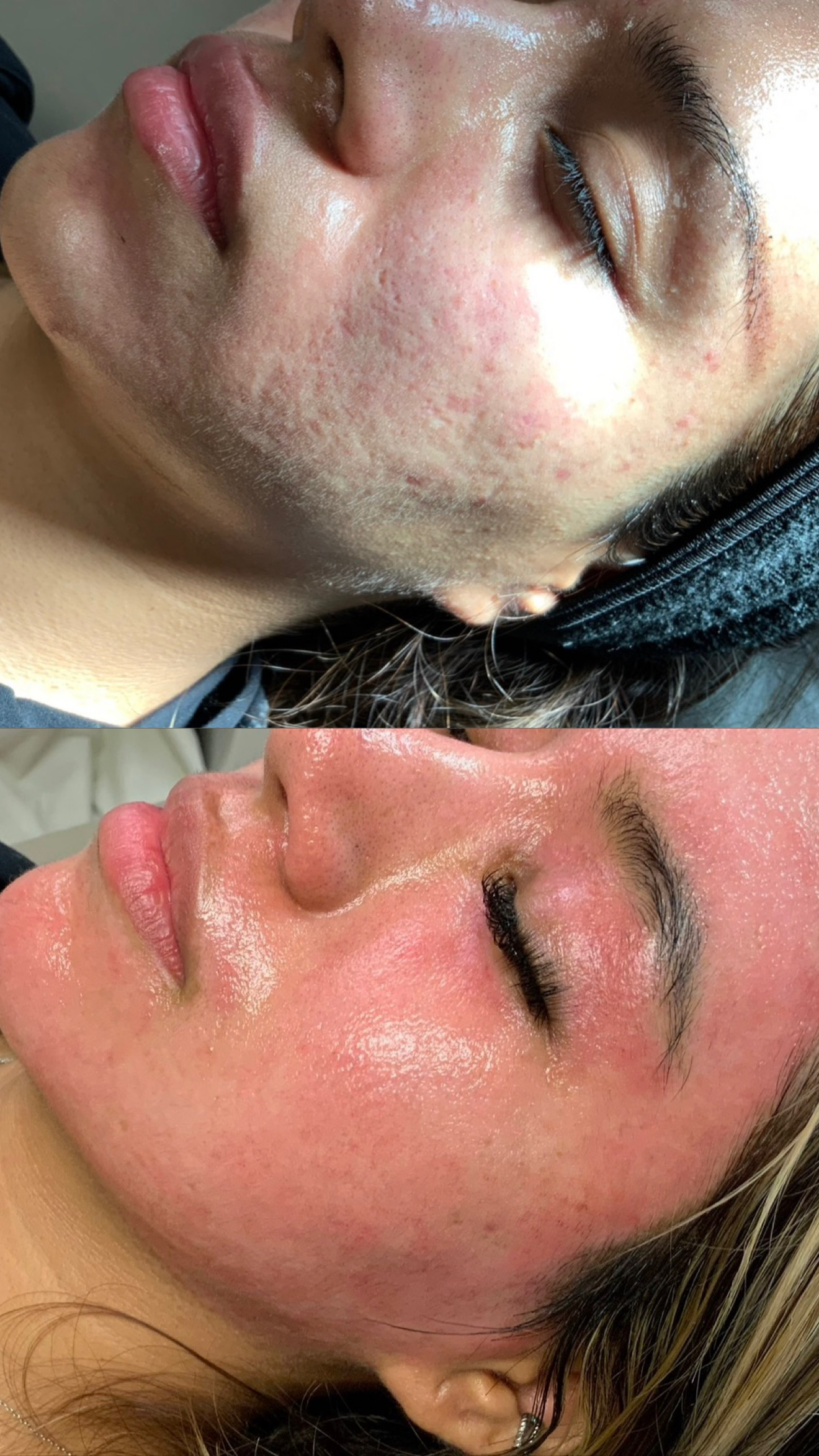 CO2 for Acne Scarring before-and-after photographs from the Aesthetix Results gallery