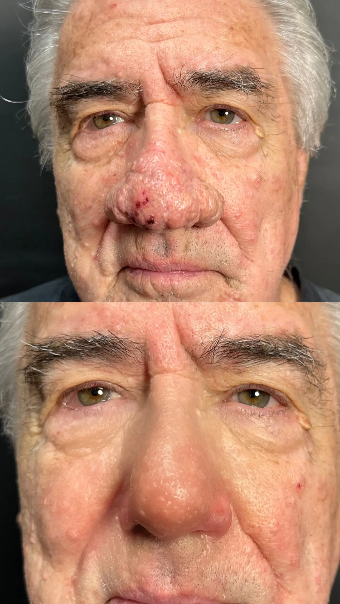CO2 for Rhinophyma before-and-after photographs from the Aesthetix Results gallery