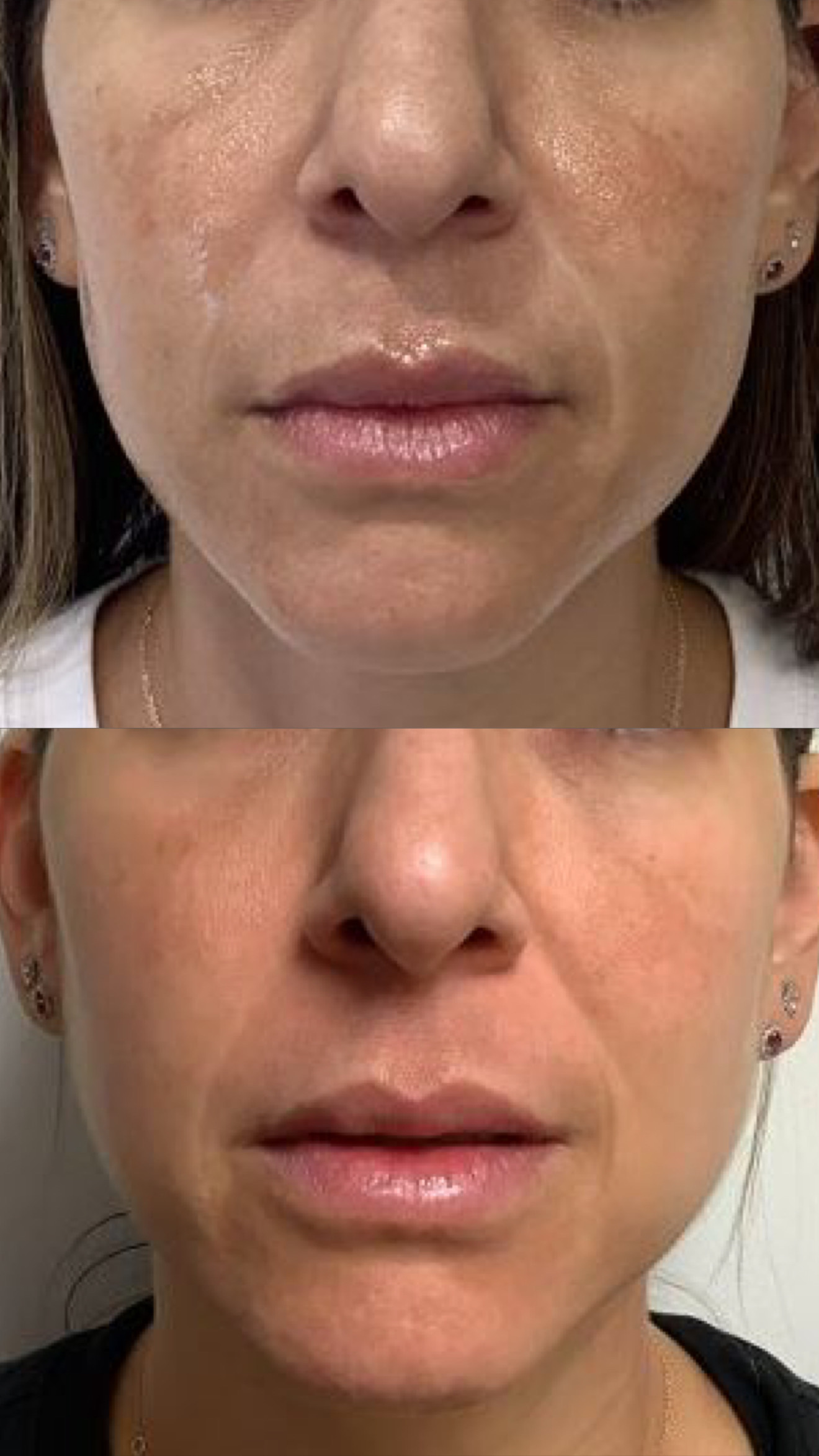 LaseMD before-and-after photographs from the Aesthetix Results gallery