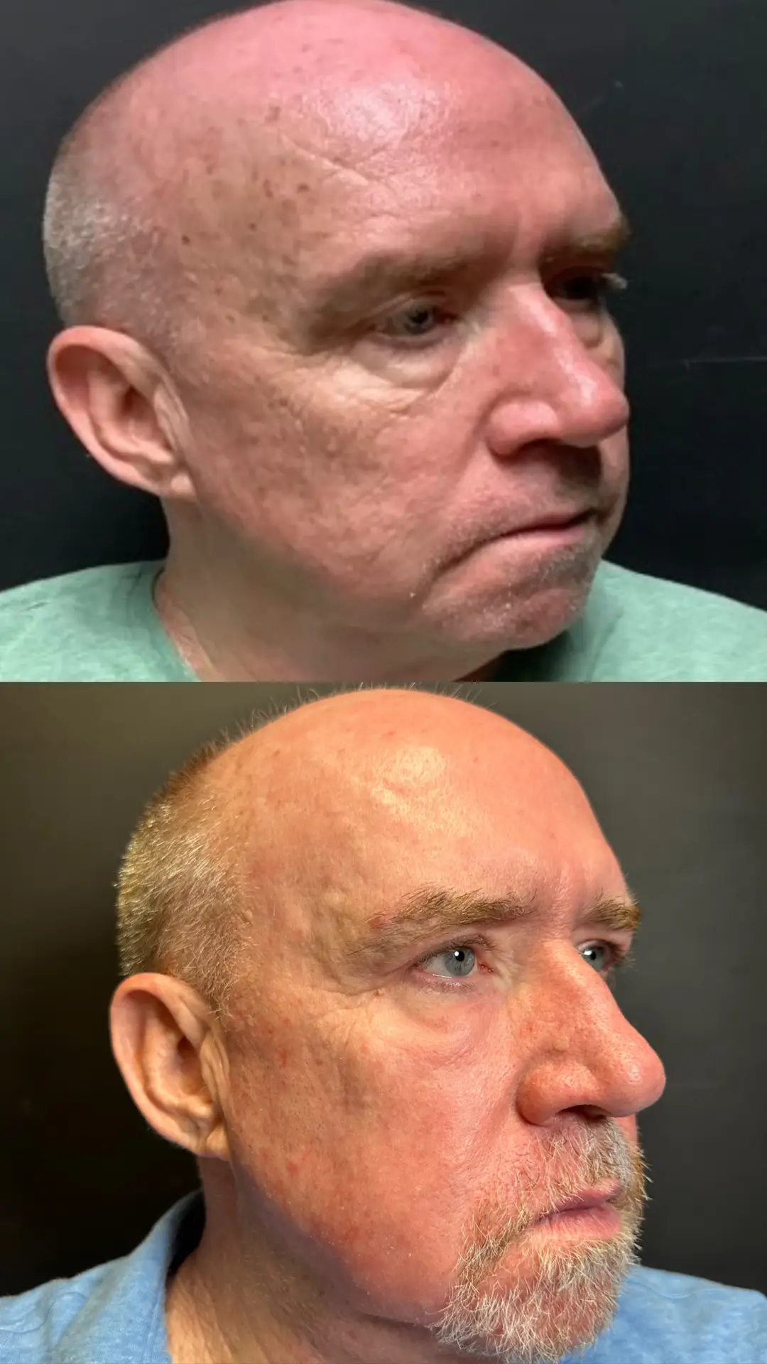 CO2 for Facial Rejuvenation before-and-after photographs from the Aesthetix Results gallery