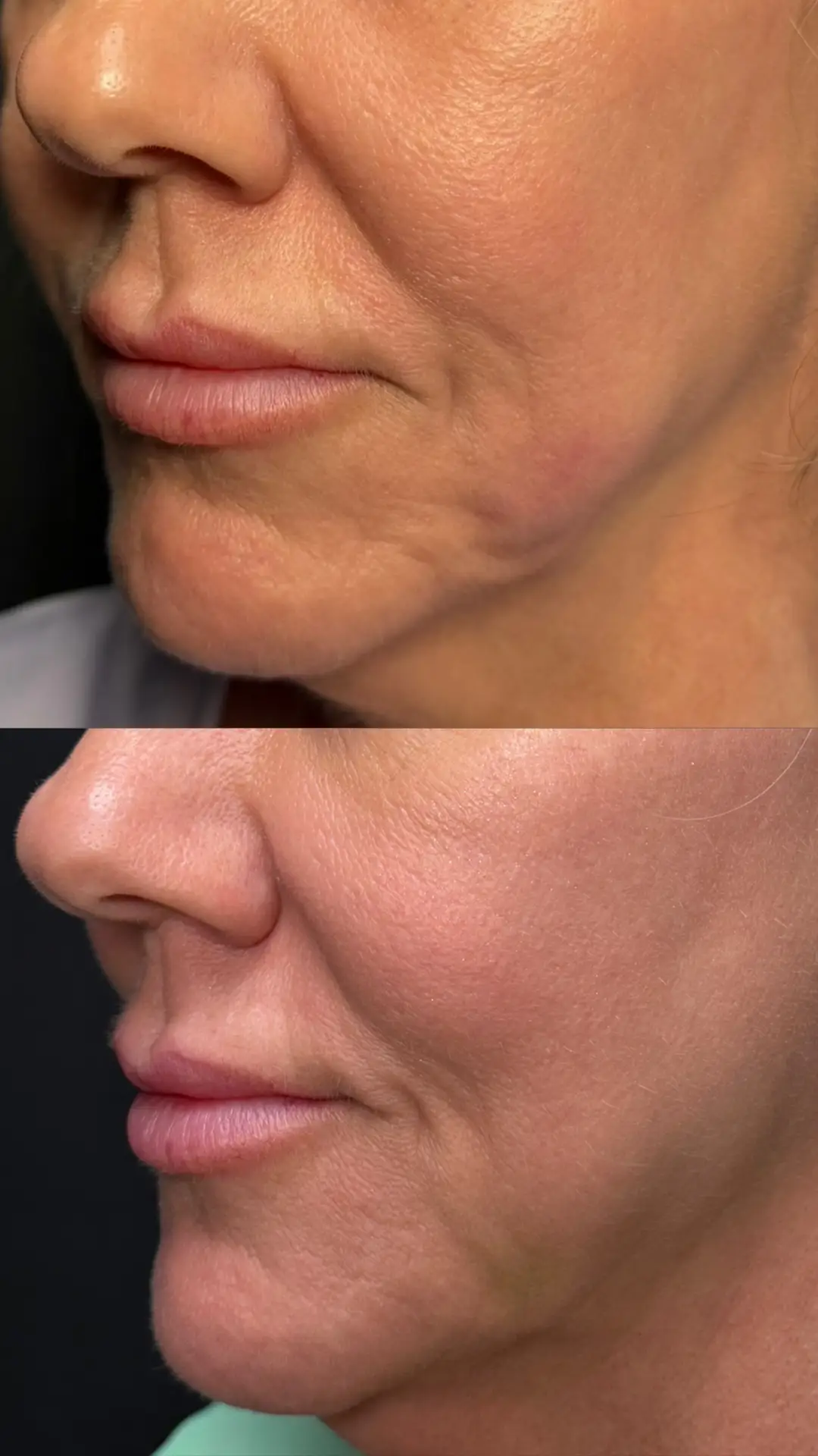 Filler before-and-after photographs from the Aesthetix Results gallery