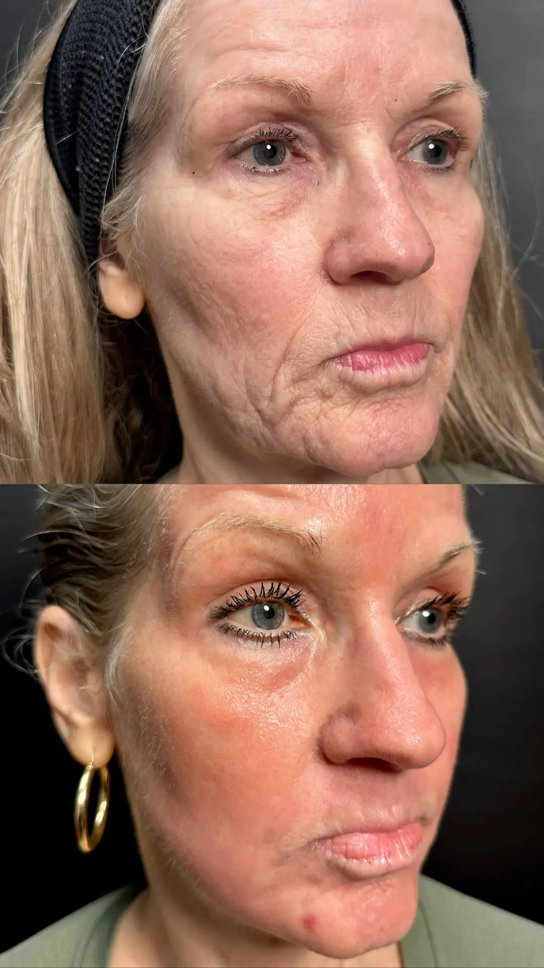 CO2 for Facial Rejuvenation before-and-after photographs from the Aesthetix Results gallery