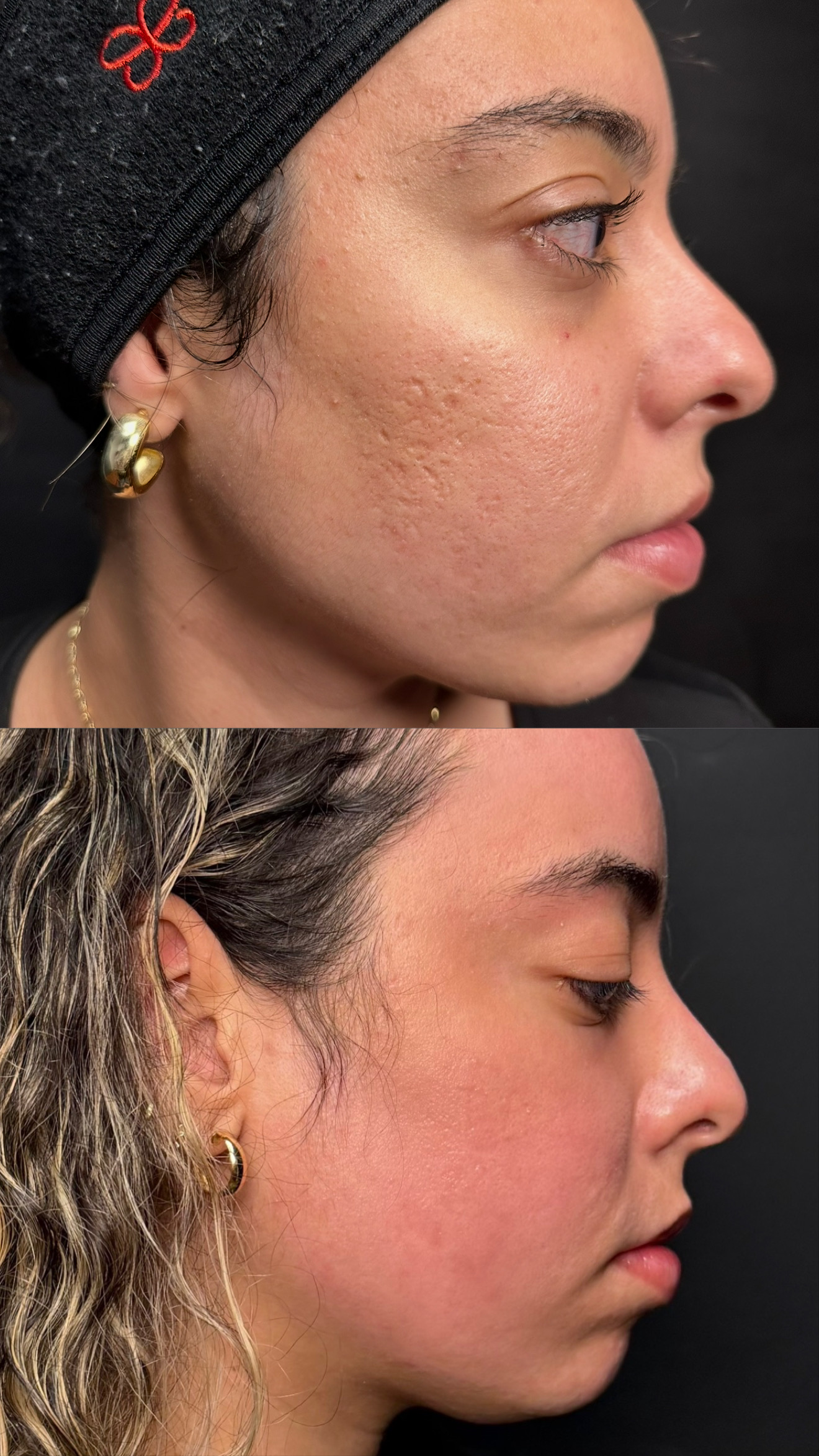 CO2 for Acne Scarring before-and-after photographs from the Aesthetix Results gallery