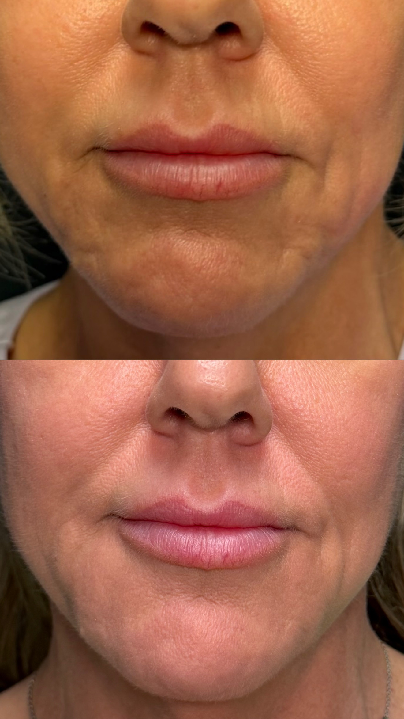 Filler before-and-after photographs from the Aesthetix Results gallery
