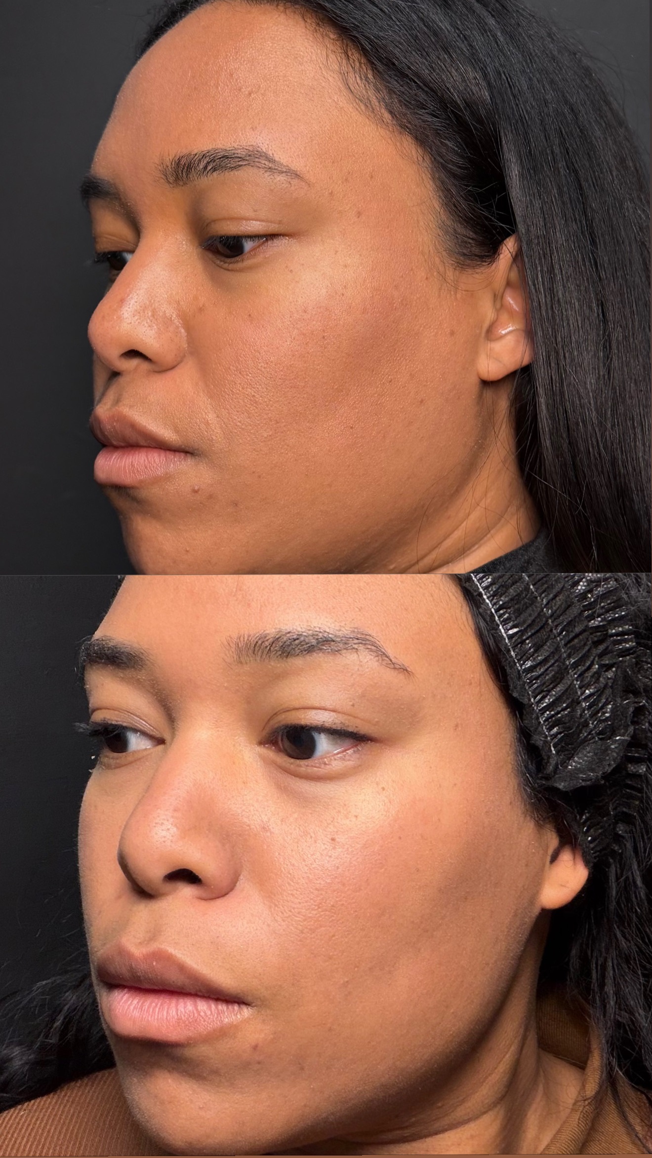 Microneedling before-and-after photographs from the Aesthetix Results gallery