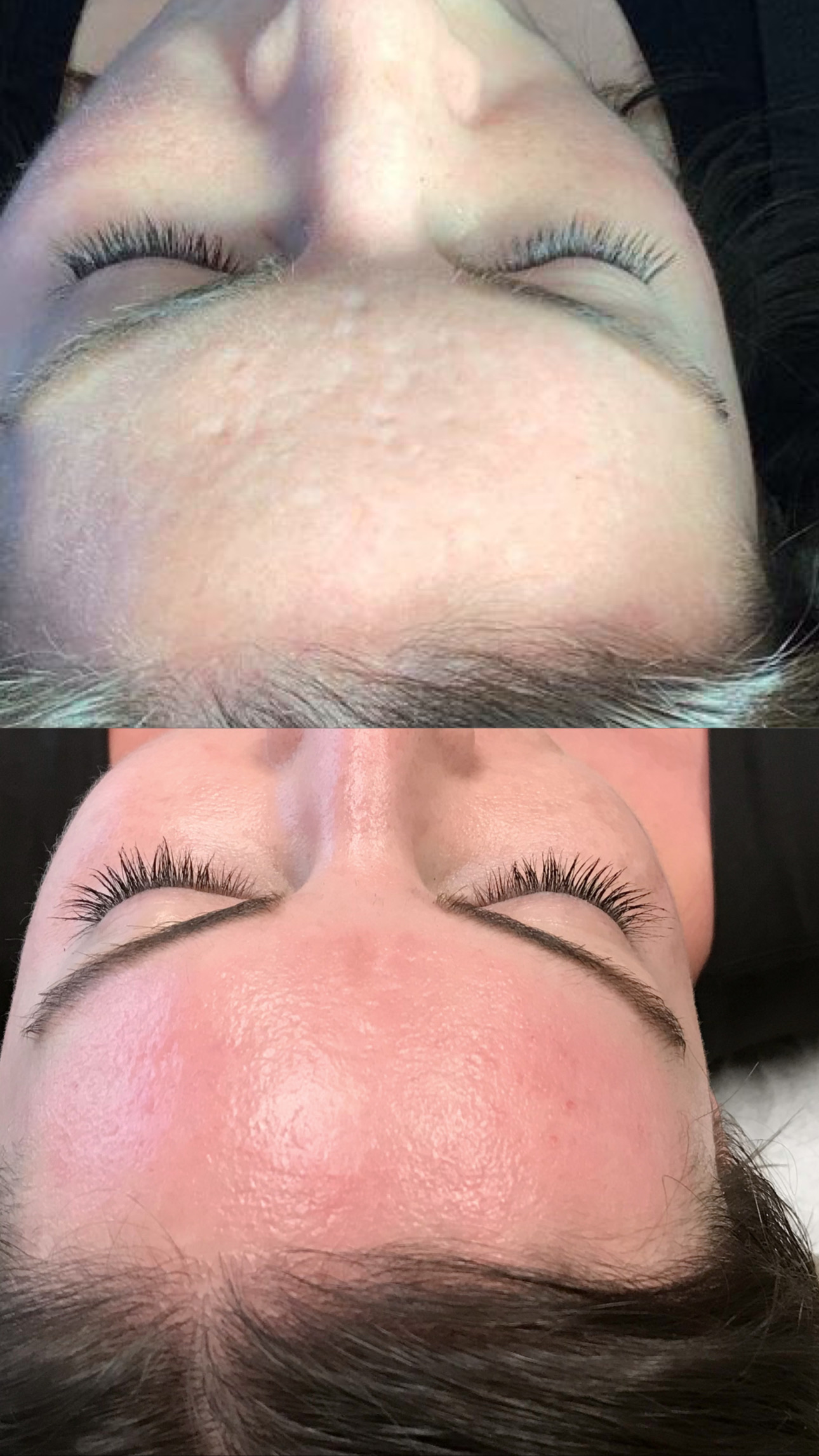 CO2 for Acne Scarring before-and-after photographs from the Aesthetix Results gallery