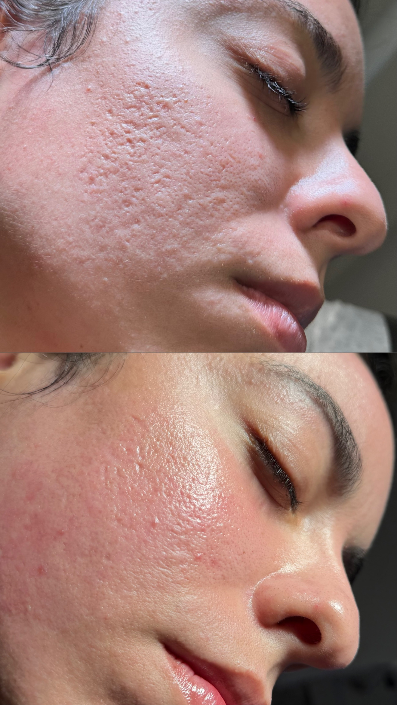 CO2 for Acne Scarring before-and-after photographs from the Aesthetix Results gallery