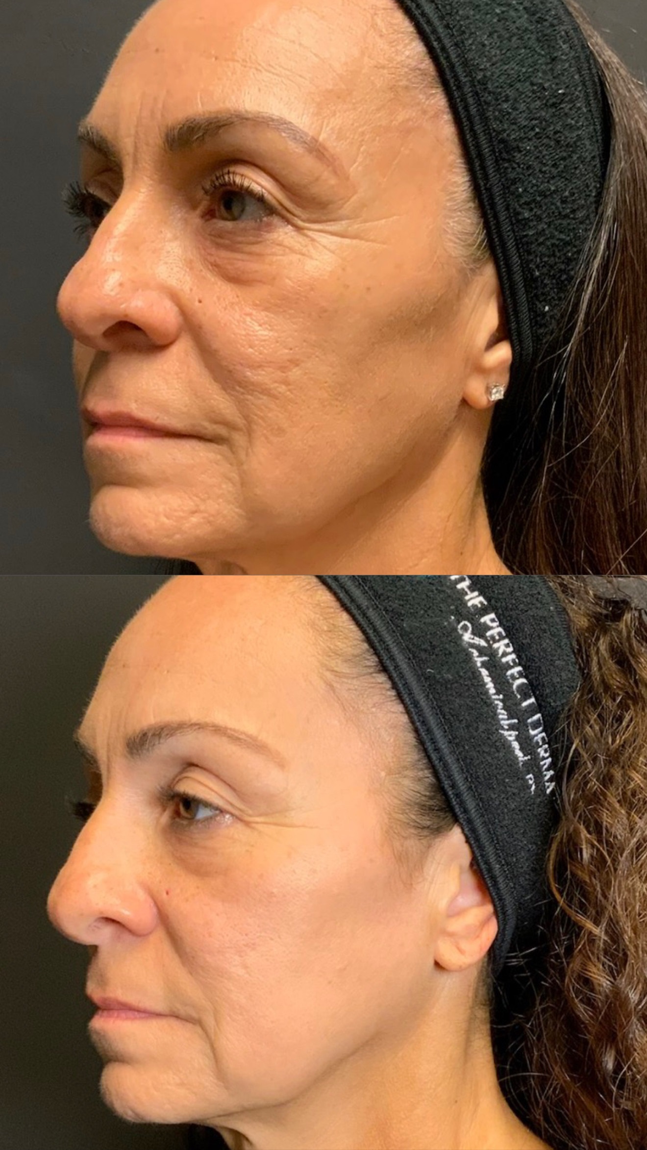 Skin Tightening before-and-after photographs from the Aesthetix Results gallery