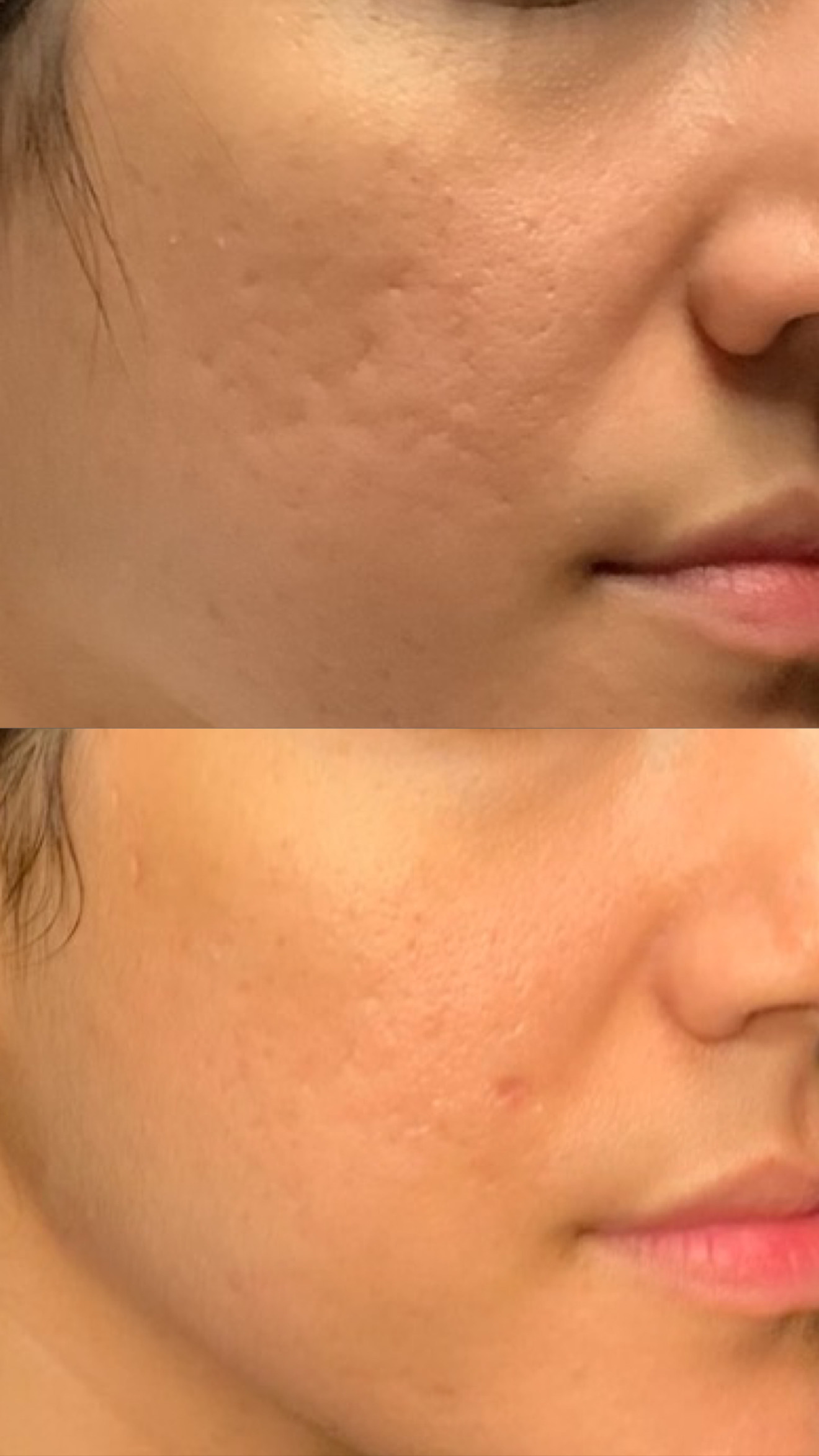 Subscision before-and-after photographs from the Aesthetix Results gallery