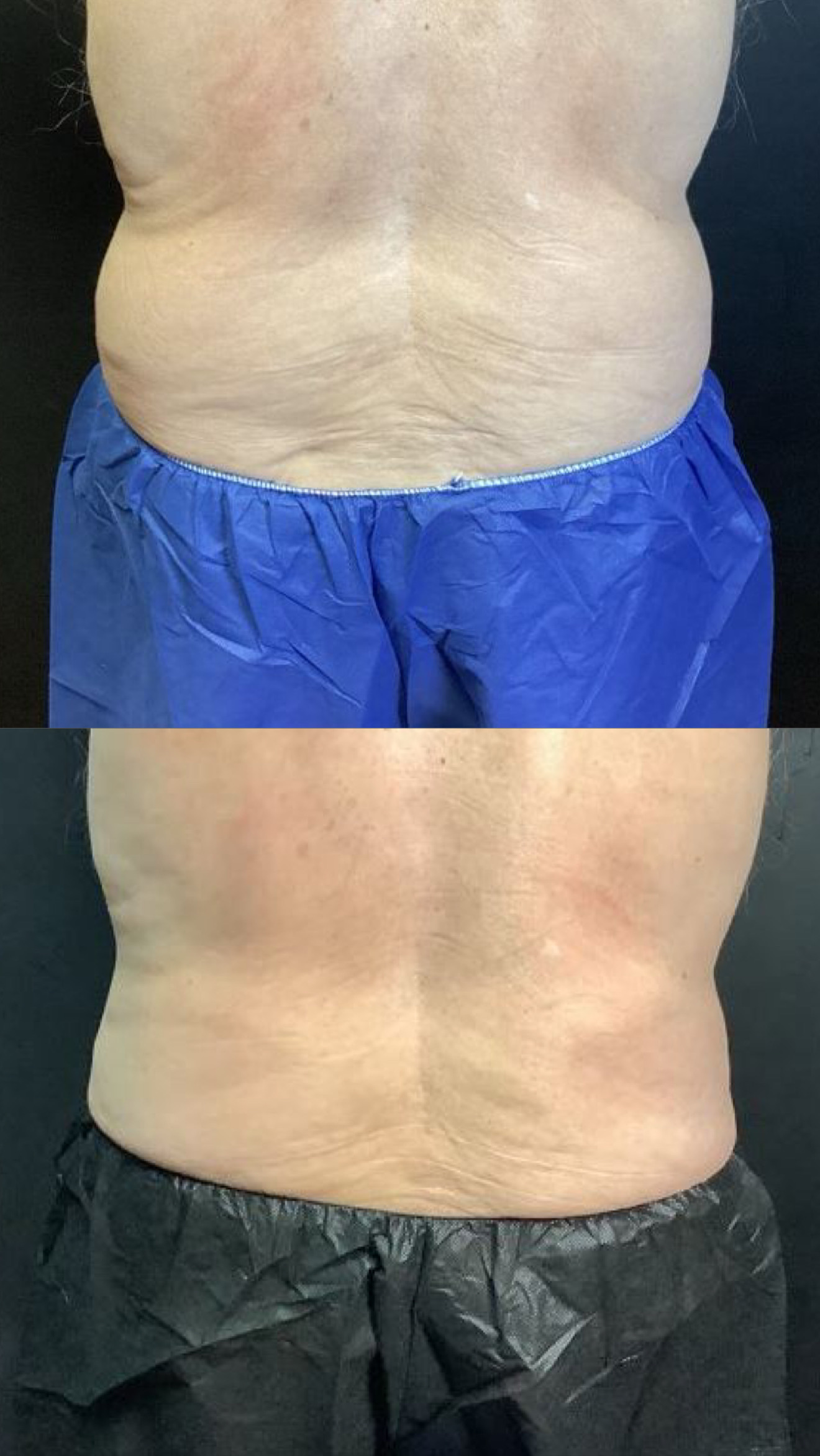 Coolsculpting before-and-after photographs from the Aesthetix Results gallery