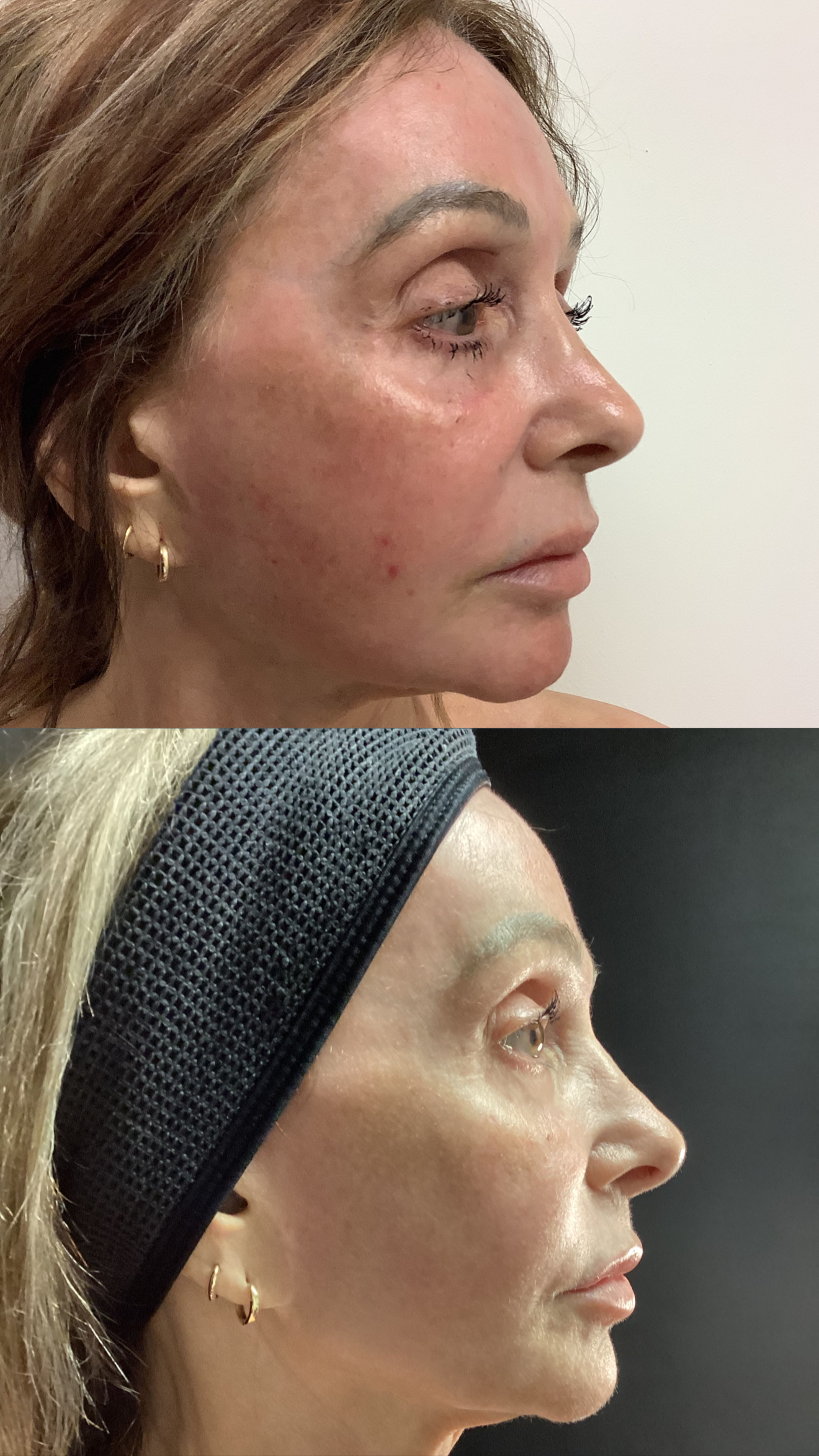 LaseMD before-and-after photographs from the Aesthetix Results gallery