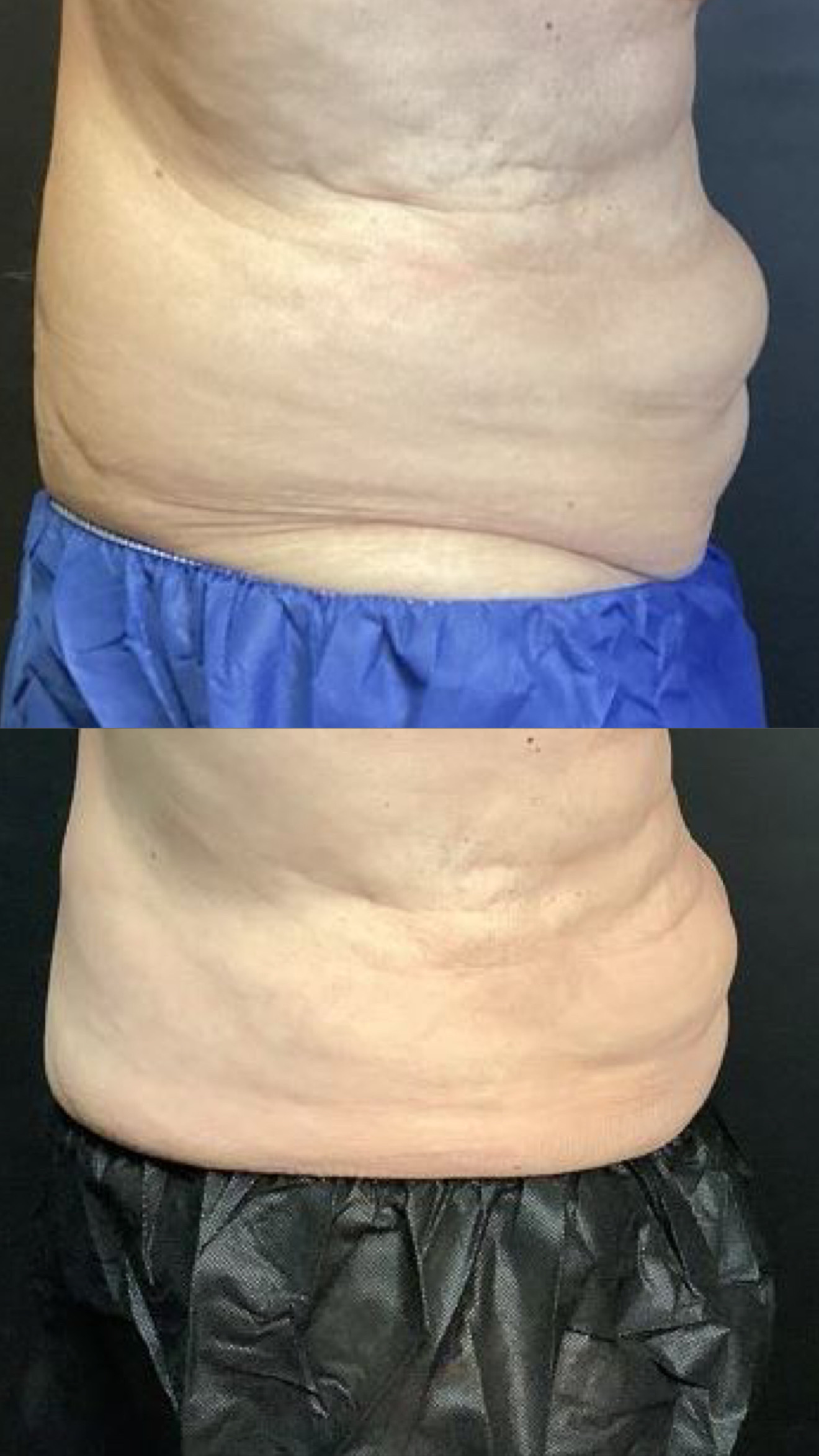 Coolsculpting before-and-after photographs from the Aesthetix Results gallery