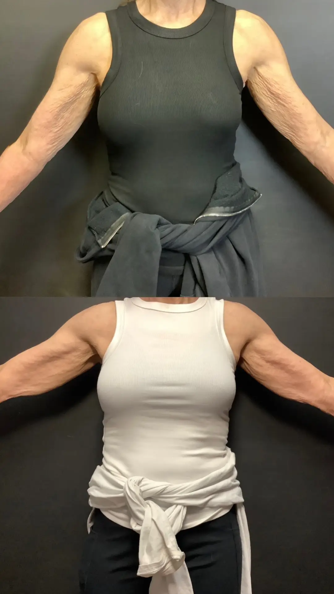Skin Tightening before-and-after photographs from the Aesthetix Results gallery