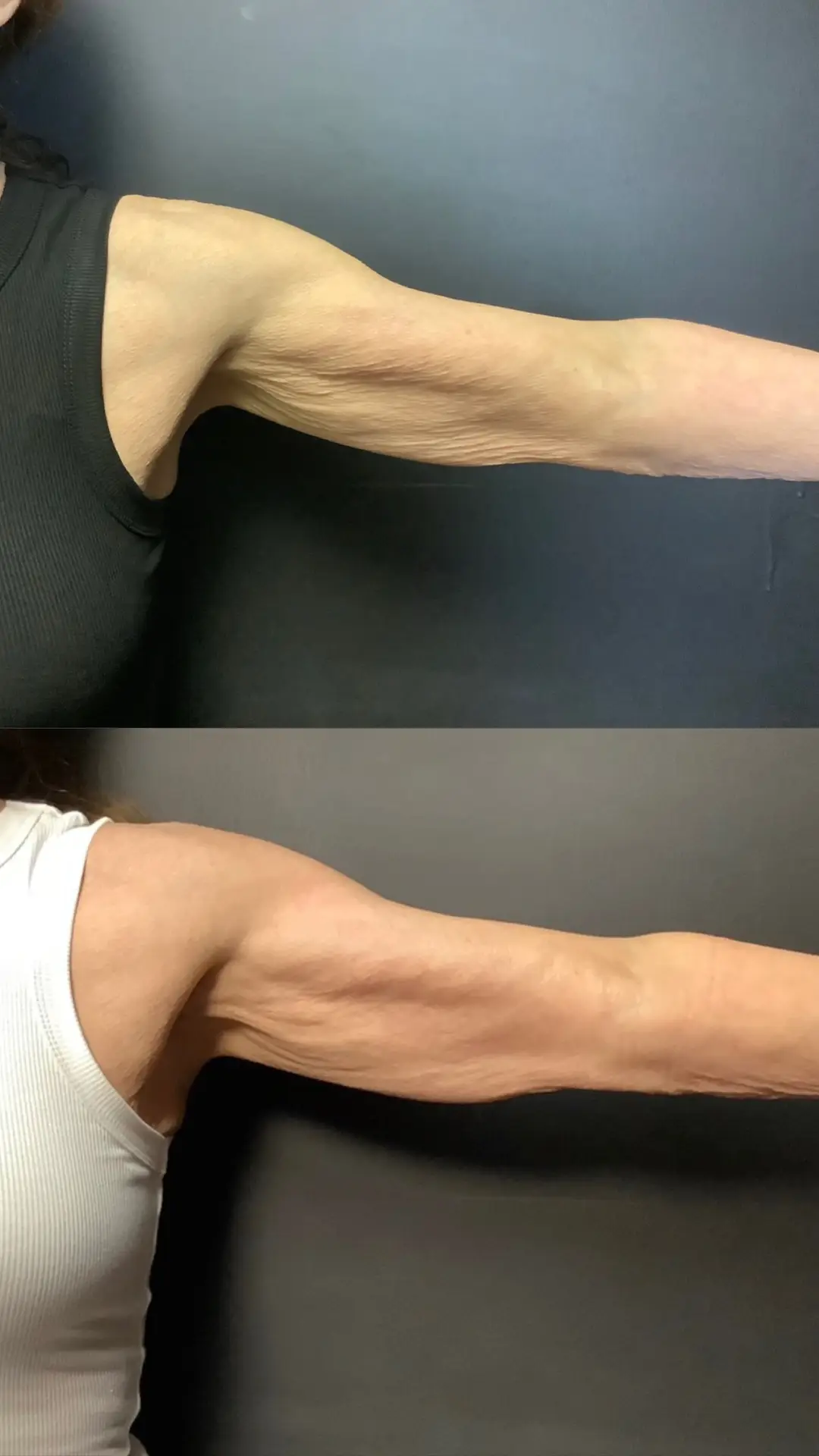 Skin Tightening before-and-after photographs from the Aesthetix Results gallery