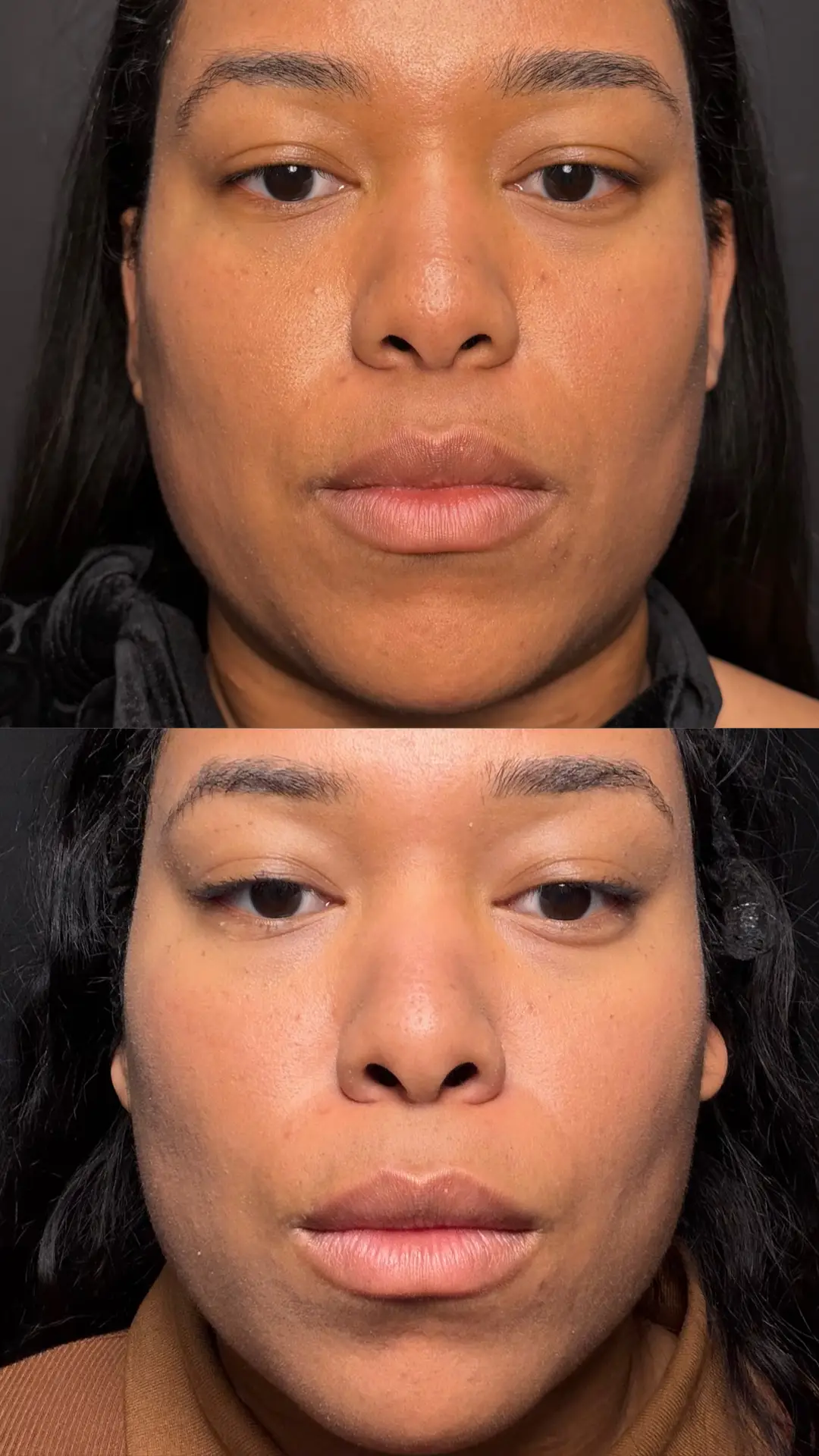 Microneedling before-and-after photographs from the Aesthetix Results gallery