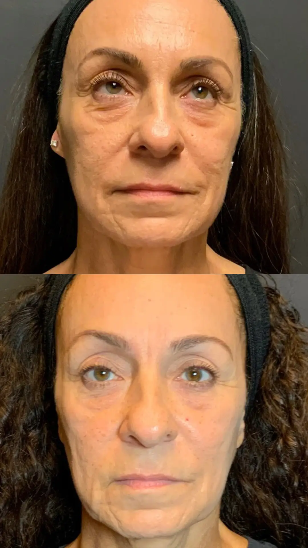 Skin Tightening before-and-after photographs from the Aesthetix Results gallery