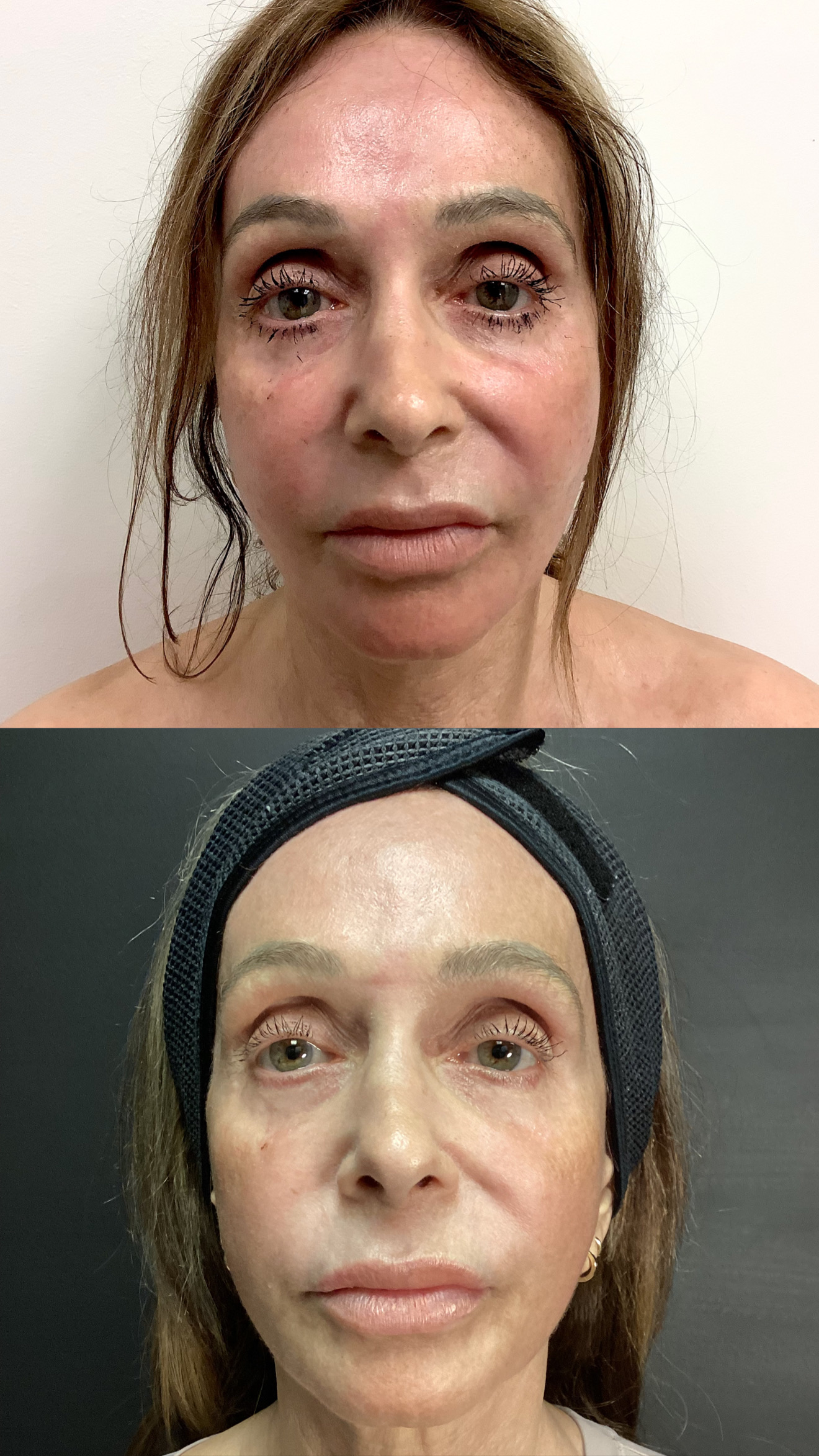 LaseMD before-and-after photographs from the Aesthetix Results gallery
