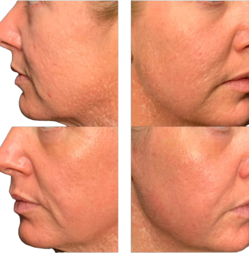 CO2 for Acne Scarring before-and-after photographs from the Aesthetix Results gallery