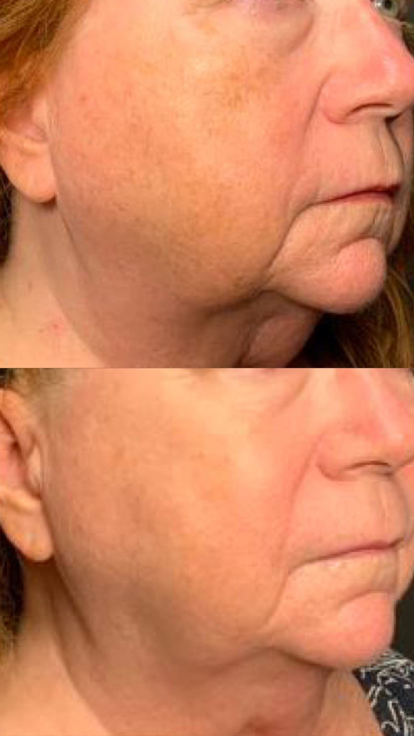 LaseMD before-and-after photographs from the Aesthetix Results gallery