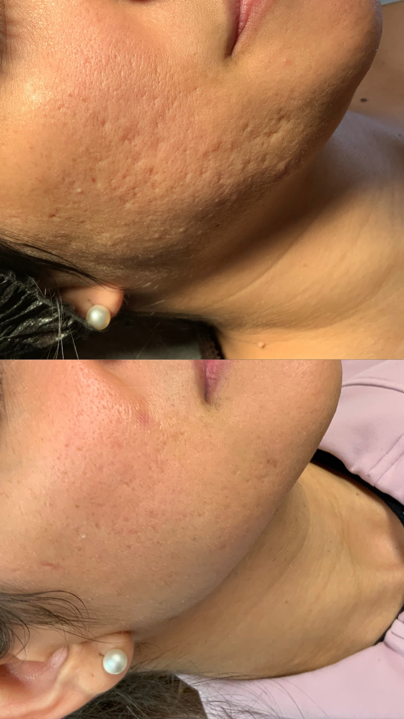 Subscision before-and-after photographs from the Aesthetix Results gallery