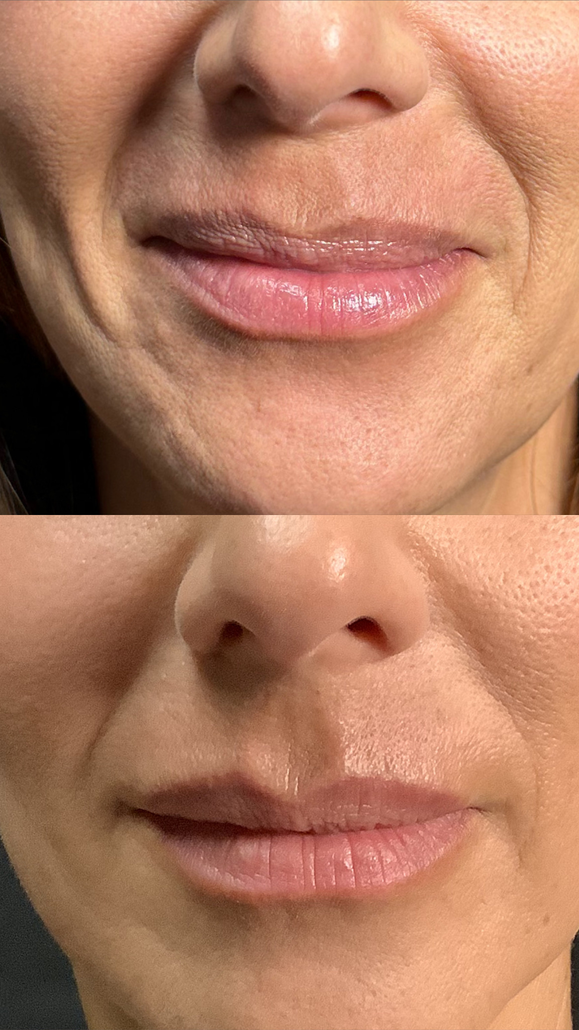 Filler before-and-after photographs from the Aesthetix Results gallery
