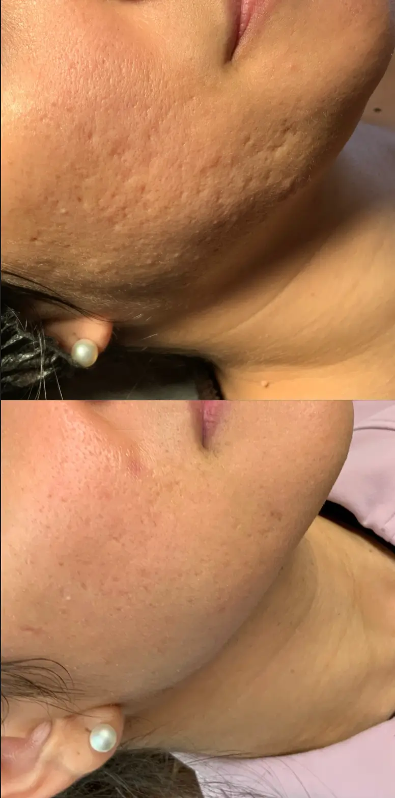 Subscision before-and-after photographs from the Aesthetix Results gallery