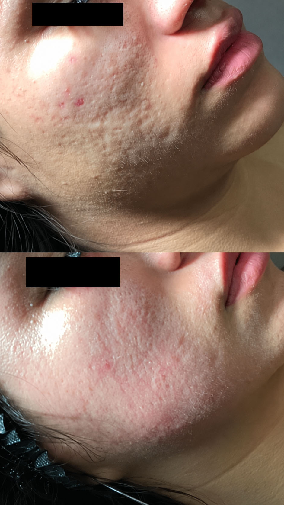 CO2 for Acne Scarring before-and-after photographs from the Aesthetix Results gallery