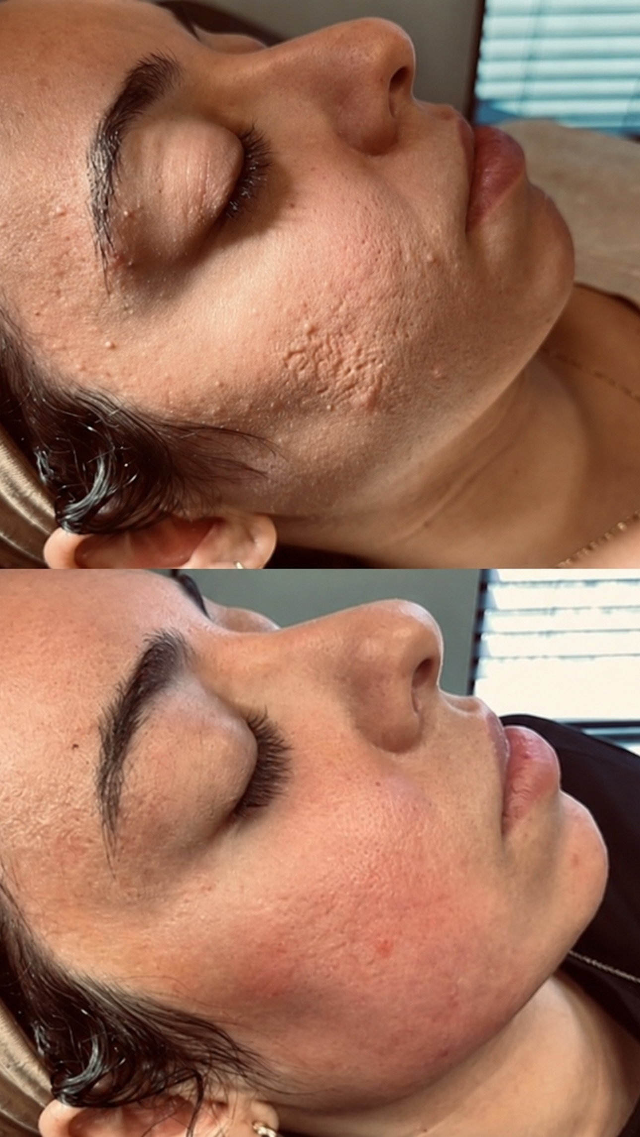 CO2 for Acne Scarring before-and-after photographs from the Aesthetix Results gallery